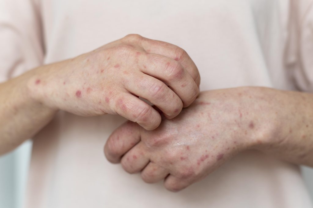 2025 Measles Outbreak: What Richmond Residents Need to Know - Richmond Medical Clinic