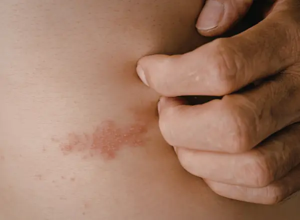 Skin Rashes & Allergic Reactions
